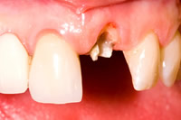 前歯の再植