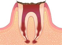 根元の虫歯