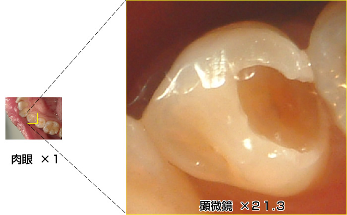マイクロスコープによる歯科治療 | 埼玉県久喜市