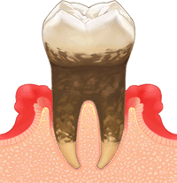 中度歯周病